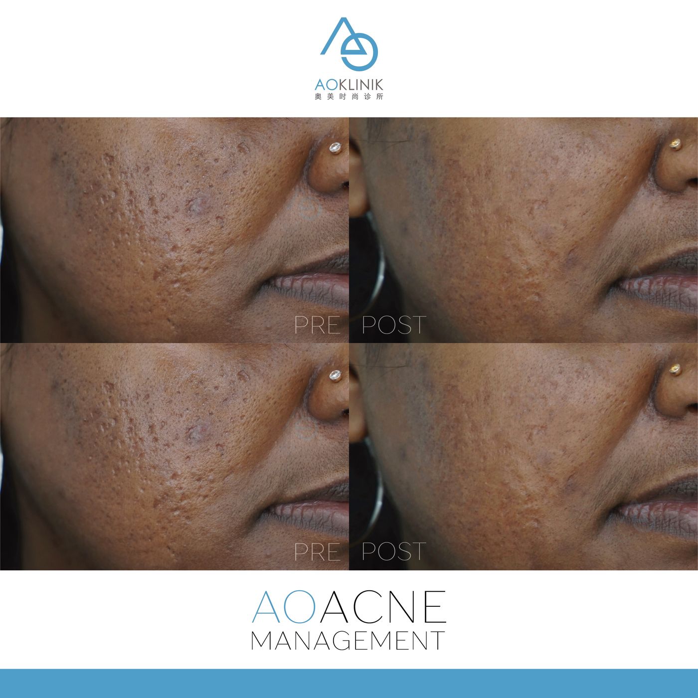 Chemical peel pigmentation brightening before and after, AOKLINIK Penang