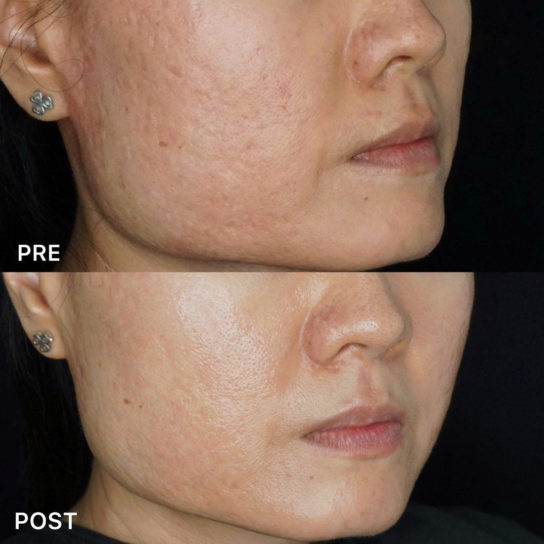 Acne scar treatment before and after at AOKLINIK Penang