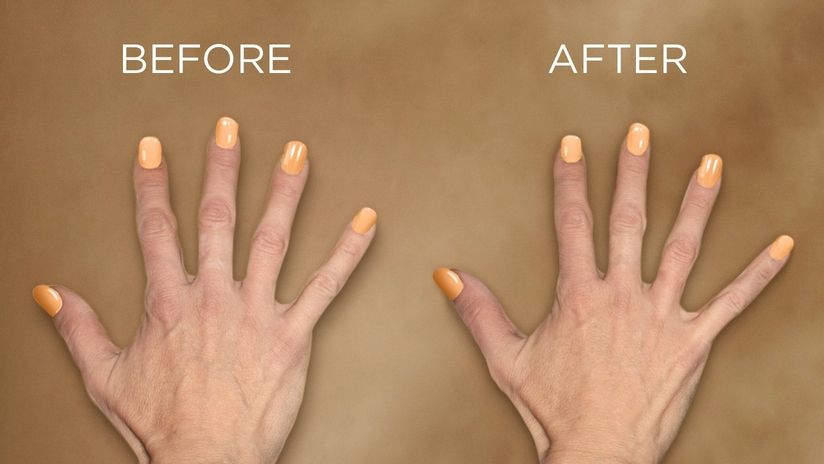 Illustrative Restylane Skinboosters hand rejuvenation