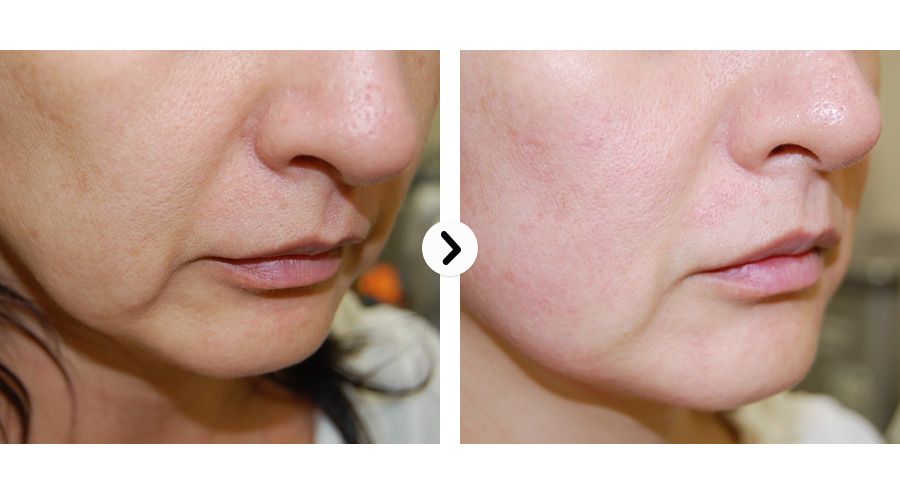 Illustrative Ultraformer HIFU result